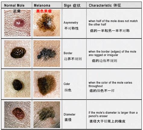 黑色的痣|痣也可能会癌变！长在 3 个地方要注意